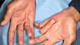 Kuvan tapauksessa on kyse Dupuytrenin kontraktuuran vaikeammasta tautimuodosta, jossa kämmenessä kohoava juoste ulottuu sormeen asti ja vetää sormet koukkuun. 