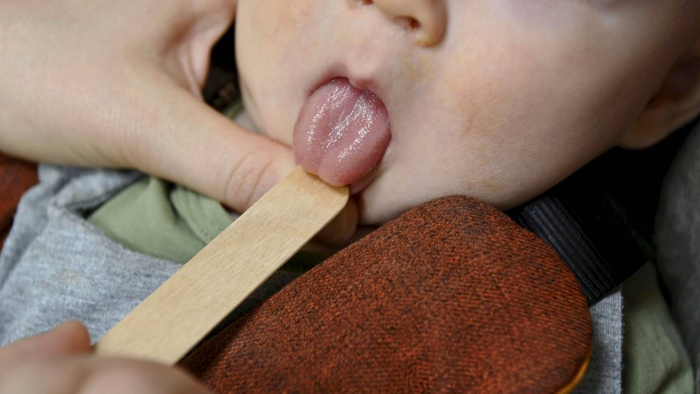 Lapset | Lastenlääkärit huolissaan: Vauvojen kielijänteitä katkaistaan satoja enemmän kuin pari vuotta sitten