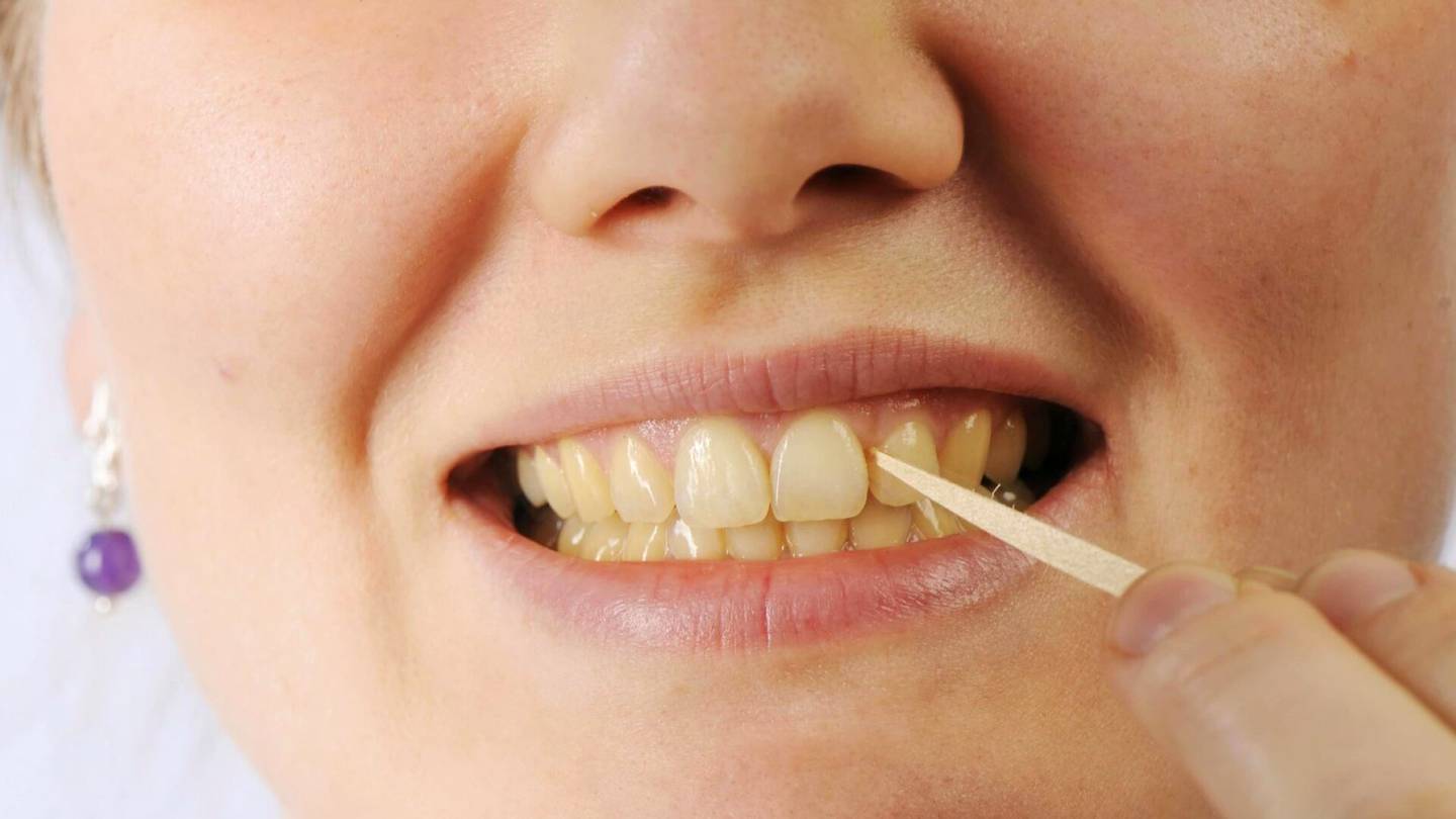 Terveys | Monen suomalaisen arjessa on tapa, joka syövyttää hampaita sala­kavalasti – Laajakin vaurio voi olla täysin oireeton, sanoo asian­tuntija