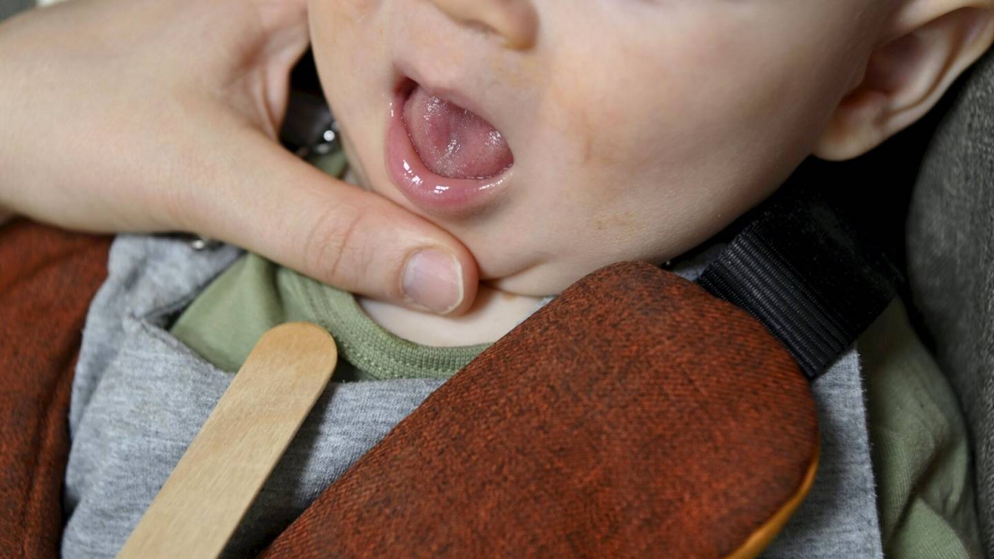Lapset | Imetys­asian­tuntija kieli­jänteen leikkauksista: ”Ei todellakaan tehdä yli­diagnosointia”