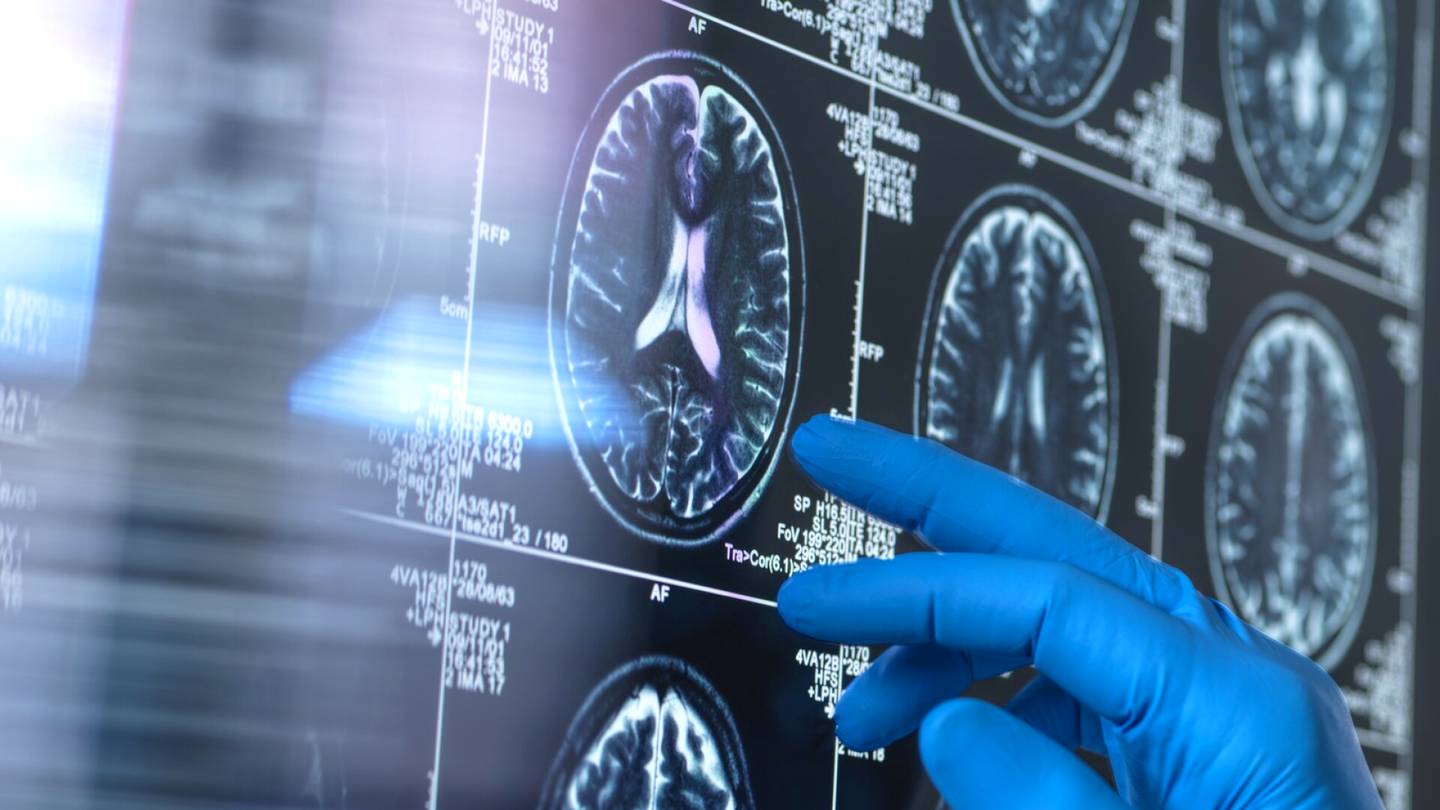 Kanada | Tutkijat väittävät viranomaisten estävän salaperäisen aivosairauden tutkimisen Kanadassa