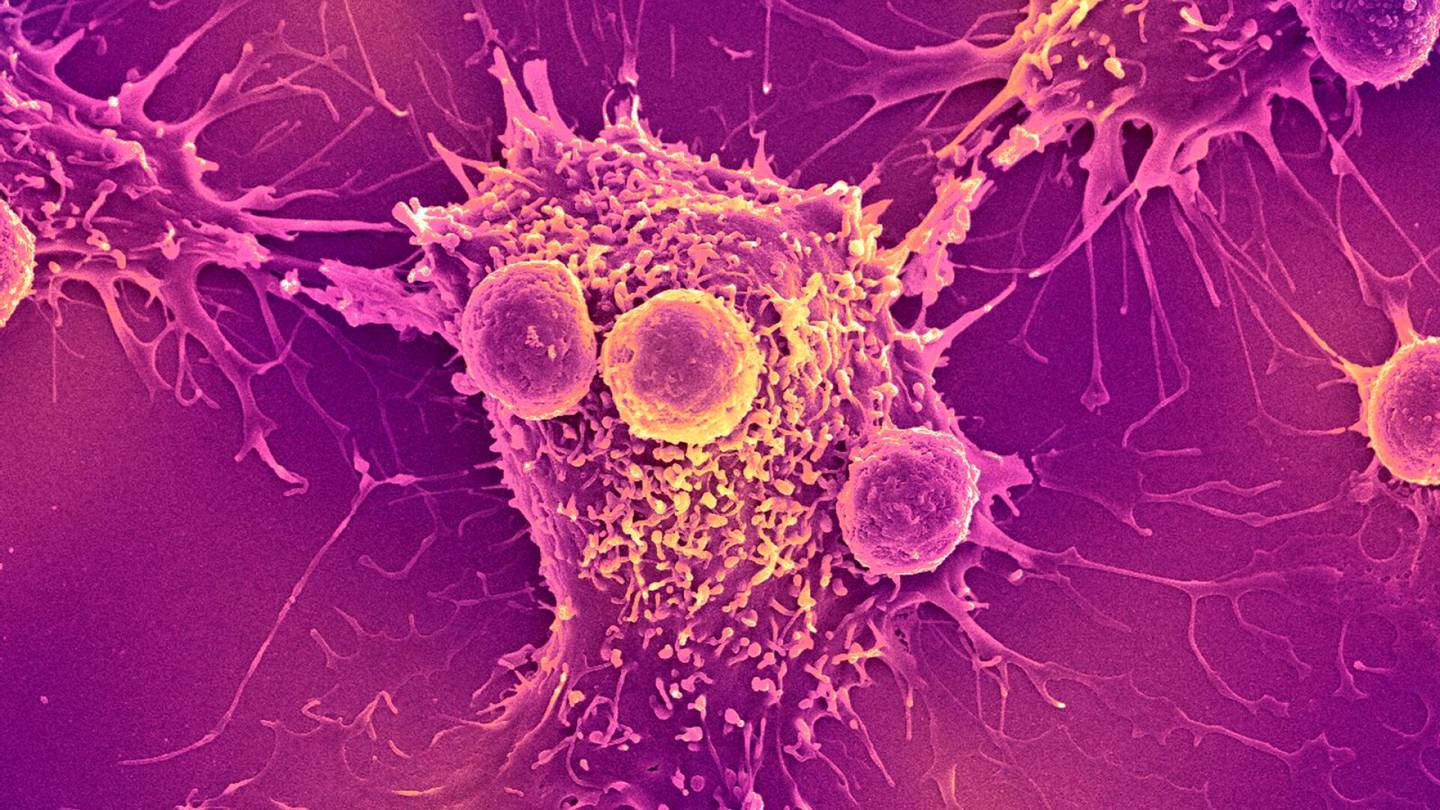 Syövän hoidot  | Syöpää vastaan uusi temppu: erityinen valo rikkoo syöpä­solujen kalvoja ”kuin katupora”