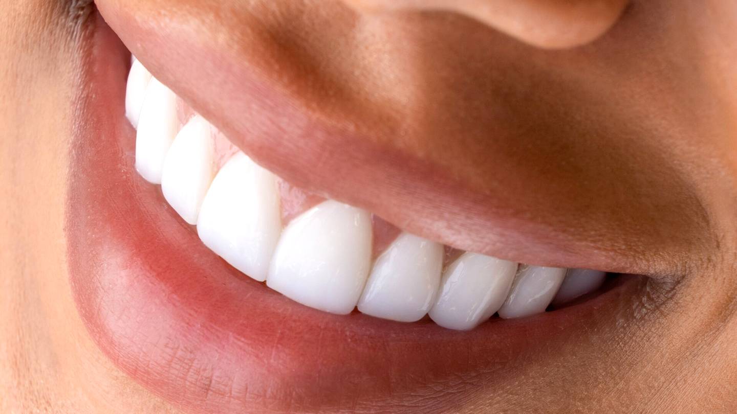 Hampaat | Somevaikuttajien kauniin hymyn hinta voi olla terveydelle kallis – Hammaslääkäri kertoo riskit, joita ei ymmärretä