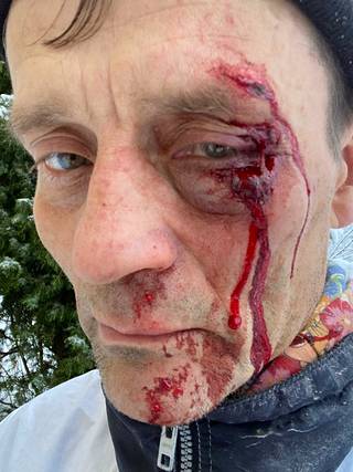 Jaakko Nisula otti valokuvan kasvoistaan onnettomuuden jälkeen.