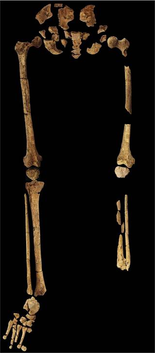 31 000 vuotta sitten eläneen henkilön vasen jalka on amputoitu säärestä.