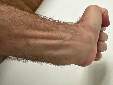 A tendon is taken from the wrist to try to make the finger work.