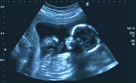 Nelikuinen sikiö äidin kohdusta otetussa ultraäänikuvassa.