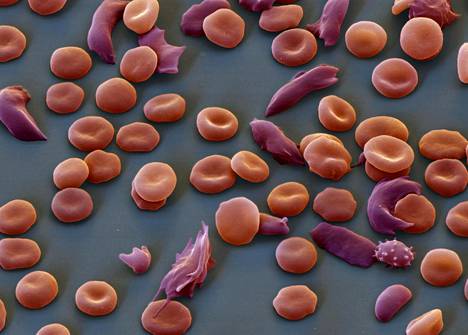 Sirppisoluanemiassa verisolut muuttuvat pyöreistä pitkulaisiksi, eivätkä toimi oikein. Elektronimikroskoopin kuva on väritetty.
