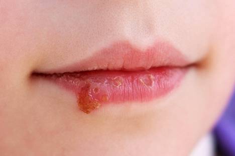 Huuliherpes tarttuu suudellessa erityisesti silloin, kun iholla on herpesrakkula tai rupi.