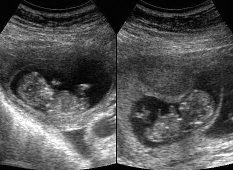 Kaksoset erottuvat ultraäänikuvassa. Kuvan kaksoset on kuvattu raskauden ensimmäisellä kolmanneksella. Vanhempien geenit eivät tiettävästi vaikuta identtisten kaksosten syntyyn, mutta taipumus saada epäidenttisiä kaksosia voi kulkea suvussa.