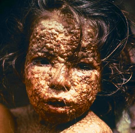 Isorokko sairastava tyttö Bangladeshissa 1973.