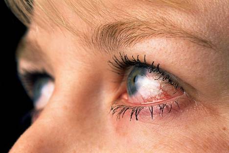 Adenovirus aiheuttaa rajuja silmätulehdusoireita.