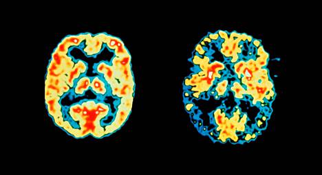Alzheimerin tauti tuhoaa aivoja. Terveet aivot ovat kuvassa vasemmalla, Alzheimerin tautia sairastavan oikealla. Positroniemissiotomografia-kuva (PET) on väritetty. Kuva ei ole jutussa mainitusta tutkimuksesta. 