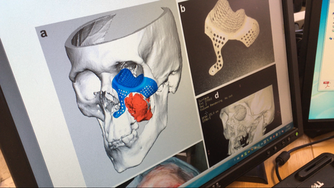 Kuvassa punaisena näkyy syöpäkasvain ja sinisenä 3d-tulostettu istute, joka tukee potilaan kasvoja leikkauksen jälkeen.