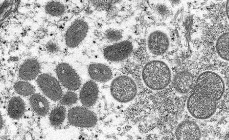 Mikroskooppikuvassa näkyy soikeita apinarokkoviruksen partikkeleita. Kuva on otettu ihmisen ihonäytteestä.