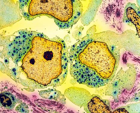 Läpäisyelektronimikroskoopin kuvassa näkyy syöpäsoluja kiveksissä.