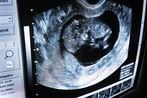 Uusi NIPT-sikiöseulonta korvaa aiemmin tarjotun alkuraskauden yhdistelmä­seulonnan Turun yliopistollisessa keskussairaalassa. Tutkimus tehdään äidin verinäytteestä alkuraskauden ultra­ääni­tutkimuksen jälkeen.