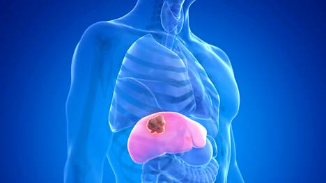 The prognosis for liver cancer is still poor. 