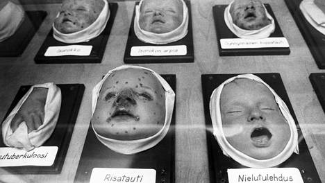 Helsinkiin rahdattiin 1920-luvulla Saksasta rujoja vahavauvoja, joiden avulla hoitajat opiskelivat tautien tunnistamista