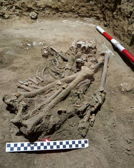 Australialaisista ja Indonesialaisista arkeologeista koostuva tutkijaryhmä löysivät todisteita 31 000 vuotta sitten toteutetusta kirurgisesta amputaatiosta nuoren metsästäjä-keräilijän jäänteistä.