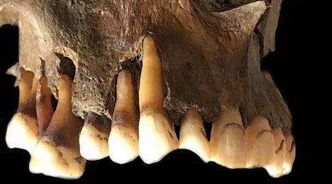 Yksi näytteistä, josta herpesvirusta löytyi, oli 1600-luvulla eläneen hollantilaisen miehen hampaista. 