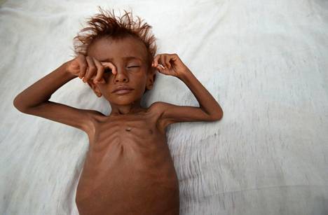 Aliravitsemuksesta kärsivä jemeniläispoika makasi sängyllä kotonaan Jemenin läntisessä Hodaidan maakunnassa, joka on pahiten ruokapulasta kärsiviä alueita.