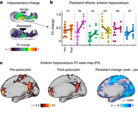 In a new study, for example, on the long-term effects of psilocybin, a test subject was selected who showed changes in the brain for the longest time.