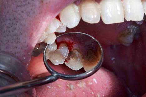 Pitkät käyntivälit lisäävät akuutin hammashoidon tarvetta, ja akuuttihoitojen osuus hammashoidossa on koko ajan kasvussa, sanoo hammaslääkäri Antti Peteri.