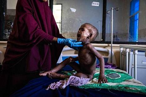 Sairaanhoitaja tutki vakavasta aliravitsemuksesta kärsivää kaksi­vuotiasta Ali Abdullahi Mohamedia sairaalassa Somalian pääkaupungissa Mogadishussa kesäkuun alussa.