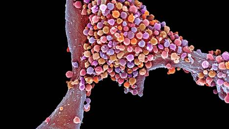 Herpesvirus on tartuttanut solun. Pyyhkäisyelektronimikroskoopin kuva on väritetty.