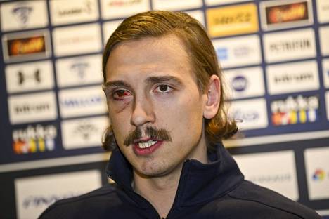 Hannes Björninen sai iskun kasvoihin MM-kisoihin valmistavassa maaottelussa, eikä silmä ole vieläkään parantunut kunnolla. 