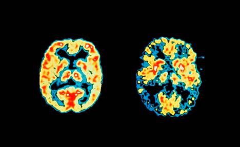 Vasemmalla normaalit aivot ja oikealla Alzheimerin tautia sairastavan potilaan aivot kuvattuna PET-kuvantamismenetelmällä. Punainen ja keltainen väri kuvastavat aivotoiminnan korkeaa aktiivisuutta, sininen ja musta alhaista. 