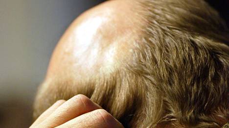 BBC: Brittitutkijat ovat saattaneet löytää uuden lääkkeen kaljuuntumiseen – luukatoon tarkoitettu lääke antoi rohkaisevia tuloksia