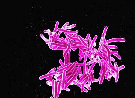 Värjätty mikroskooppikuva tuberkuloosibakteerista (Mycobacterium tuberculosis).
