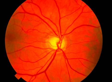 Silmänpainetauti eli glaukooma näkyy verkkokalvon vaurioina. Niitä on herkimmin silmänpohjassa sijaitsevan näköhermon päässä, Terveyskirjasto toteaa.