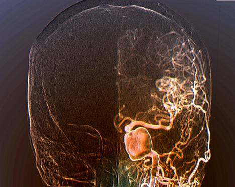 Röntgenkuva paljastaa aivovaltimo­pullistuman eli aneyrusman 45-vuotiaan miespotilaan päässä.
