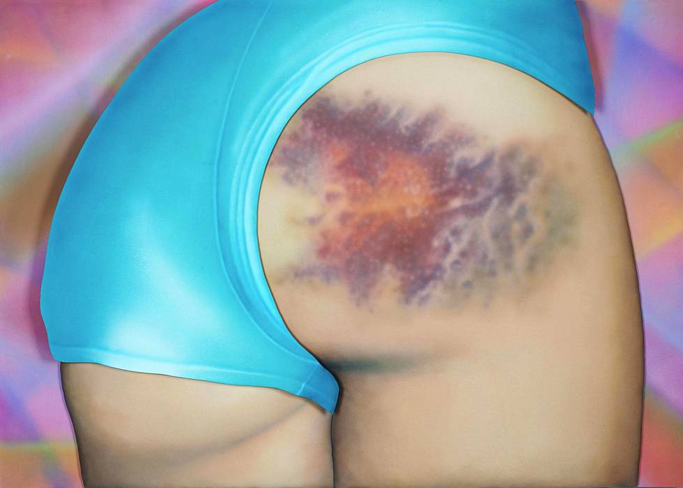 I have a really beautiful bruise on my bum. Do you want to see a pic? It has 12 colours and is the size of my head,