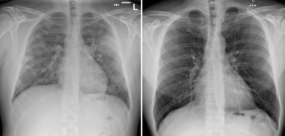 Koronaviruksen aiheuttama tauti aiheuttaa muutoksia keuhkoissa. Röntgenkuvassa vasemmalla koronapotilaan keuhkot ja verrokkina oikealla terveet keuhkot.  Kuvat ovat suomalaisesta sairaalasta, jonka nimeä HS ei julkaise potilaiden yksityisyyden suojaamiseksi. 