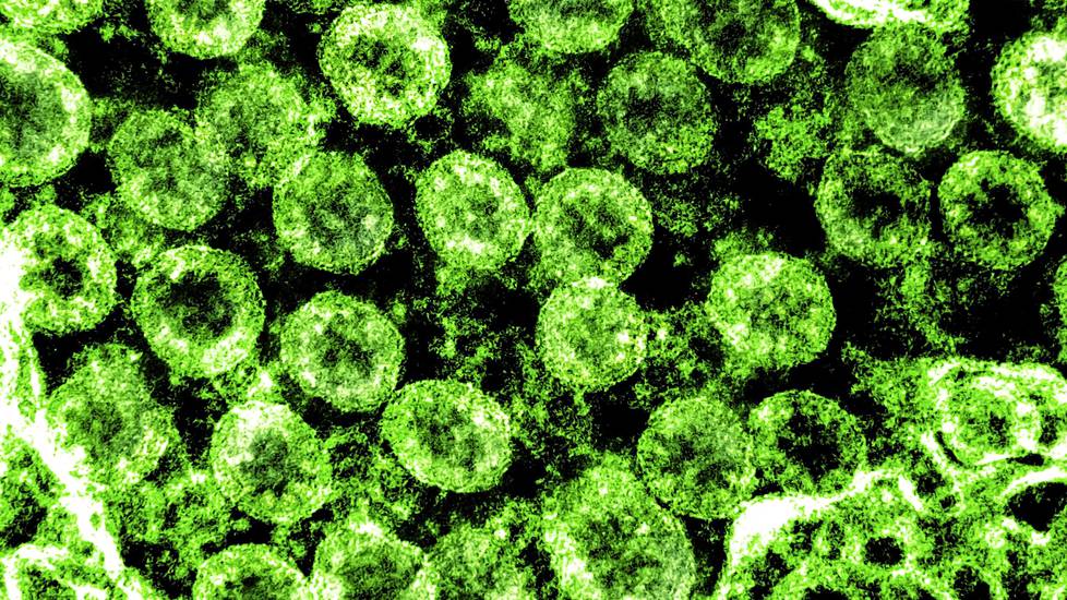 Läpäisyelektronimikroskoopin kuvassa on koronaviruksia covid-19-potilaasta Yhdysvalloissa. Kuva on väritetty.