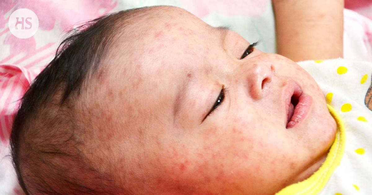 Tuhkarokko lisääntyy myös Euroopassa, THL suosittaa ylimääräistä rokotetta  osalle matkustavista vauvoista - Kotimaa 