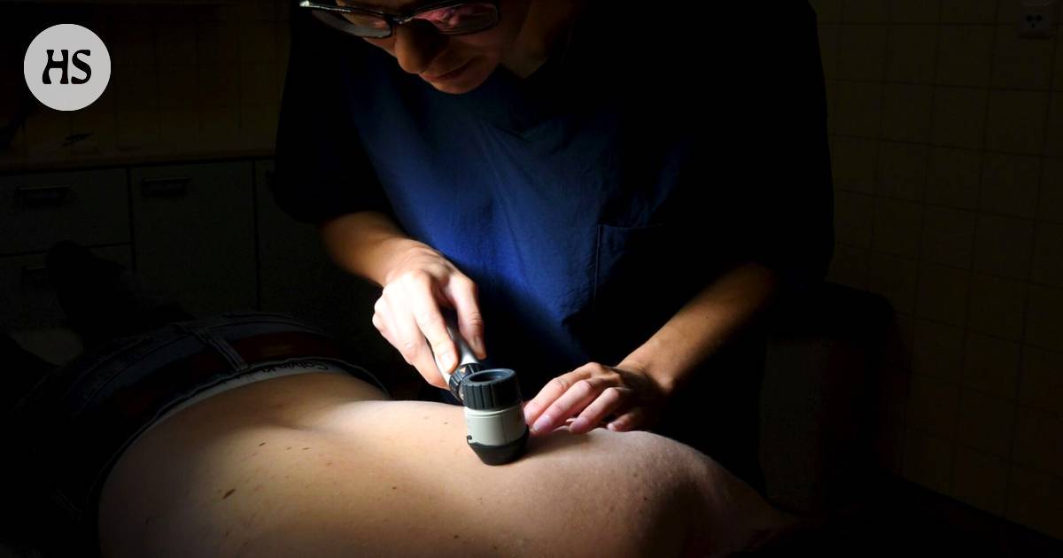 Ihotautilääkäri tutki yli 500 suomalaisen ihon päästä varpaisiin, ja tulos  oli hälyttävä – Näin piilevän ihosyövän tunnistaa - Hyvinvointi 